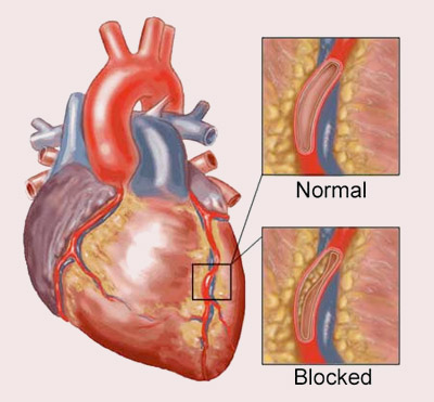 Coronary Arterery Disease